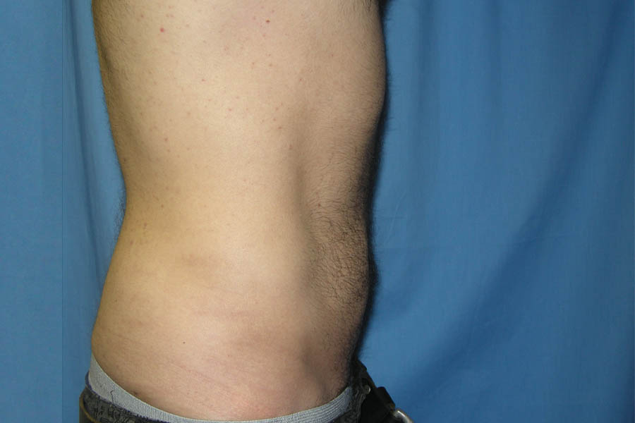 Liposuction case #4748