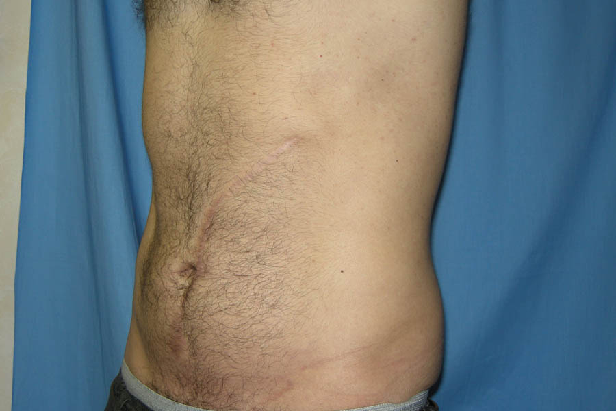Liposuction case #4748