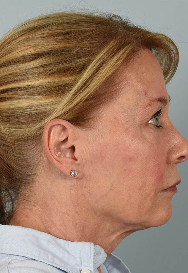 Neck Lift case #5214