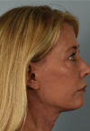 Neck Lift case #5214