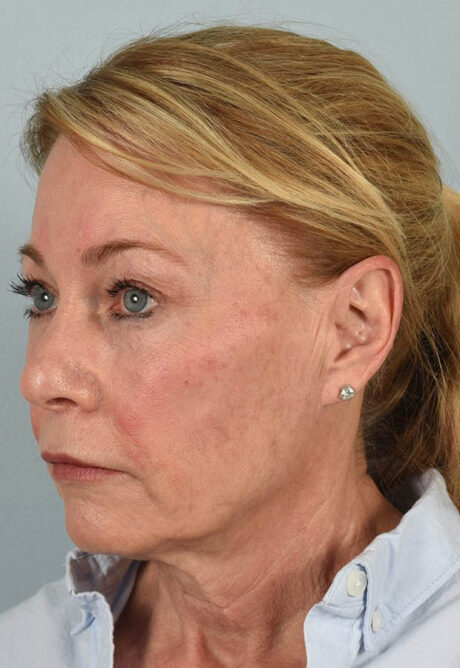 Neck Lift case #5214