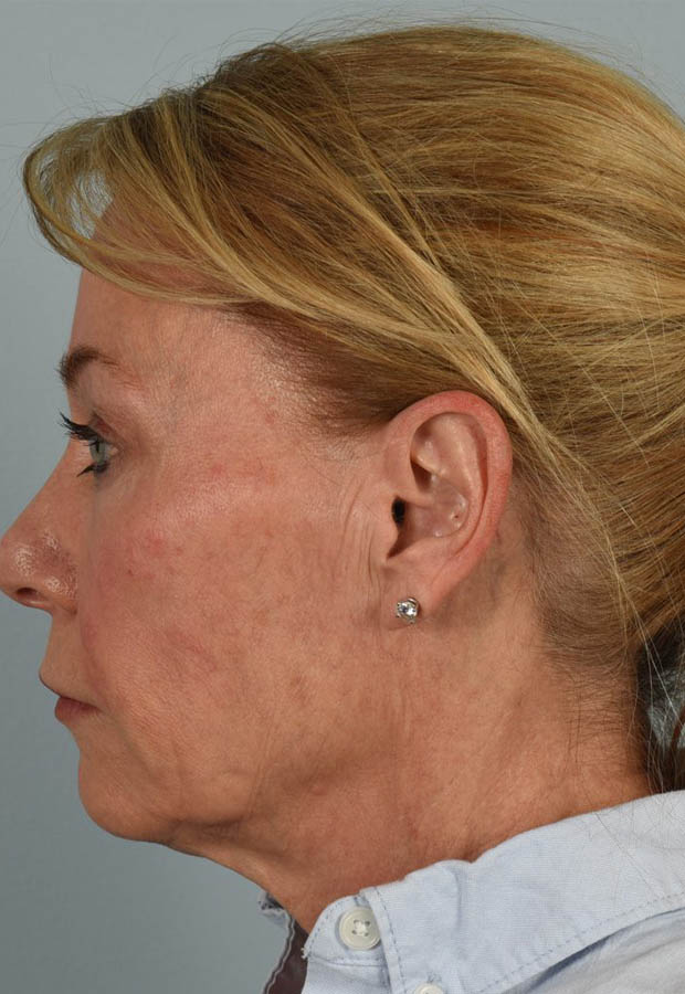 Neck Lift case #5214
