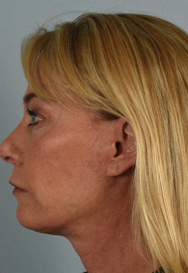 Neck Lift case #5214
