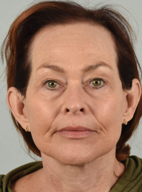 Facelift case #4217
