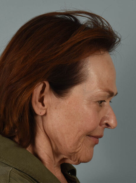 Facelift case #4217