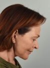 Facelift case #4217