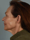 Facelift case #4217