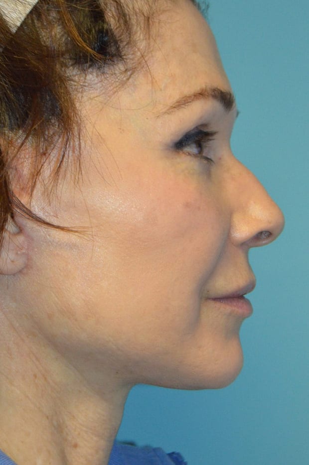 Microneedling case #3674