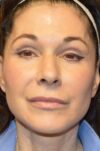 Microneedling case #3674