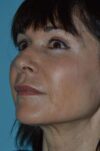 Microneedling case #3674