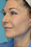 Microneedling case #3674