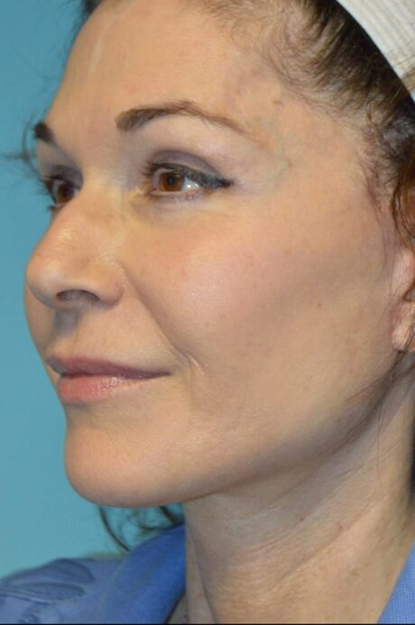 Microneedling case #3674