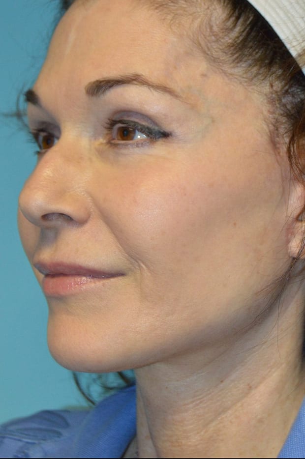 Microneedling case #3674