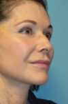 Microneedling case #3674