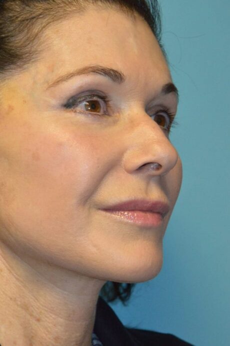 Microneedling case #3674