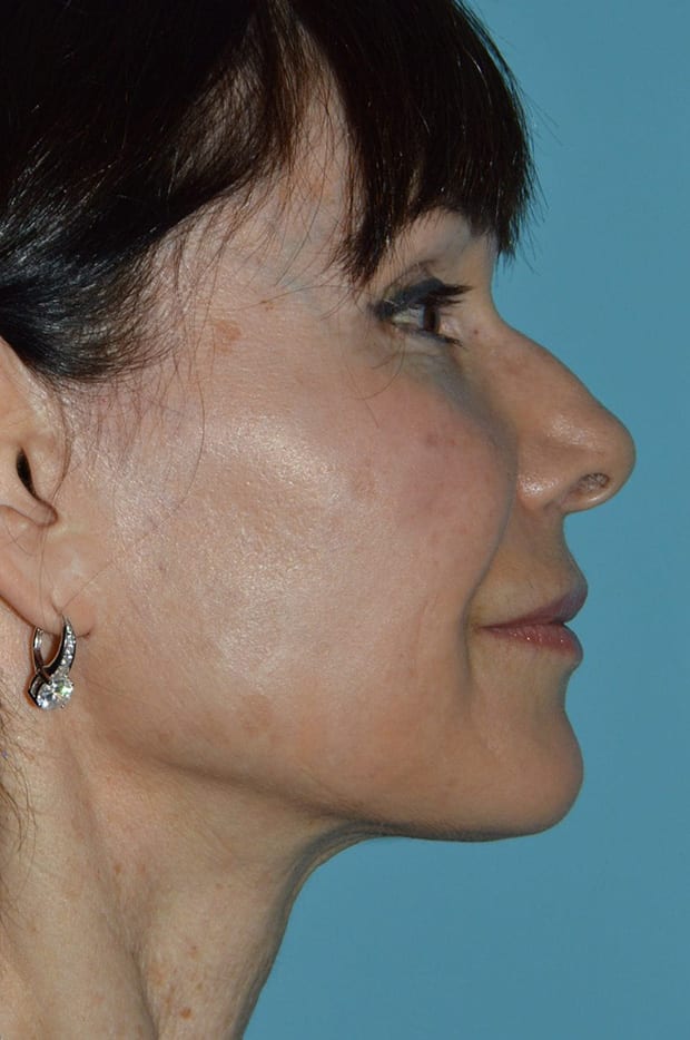 Microneedling case #3674