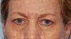 Forehead Lift case #4434