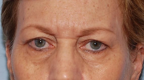 Forehead Lift case #4434