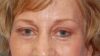 Forehead Lift case #4434