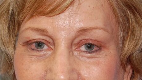 Forehead Lift case #4434