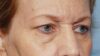 Forehead Lift case #4434