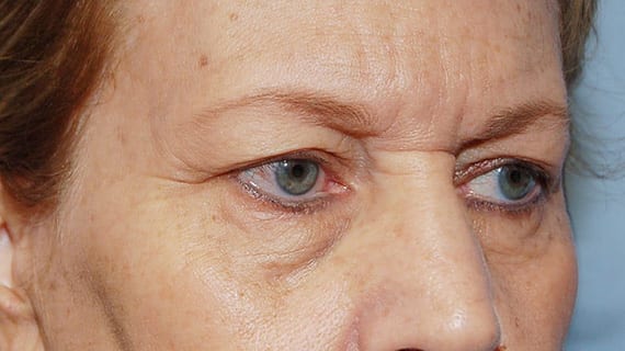 Forehead Lift case #4434