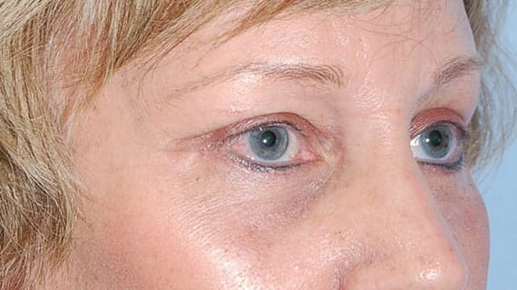 Forehead Lift case #4434