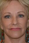 Eyelid Surgery case #3773