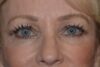 Eyelid Surgery case #3773