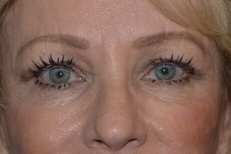 Eyelid Surgery case #3773