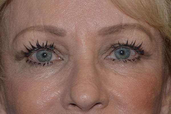 Eyelid Surgery case #3773