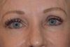 Eyelid Surgery case #3773