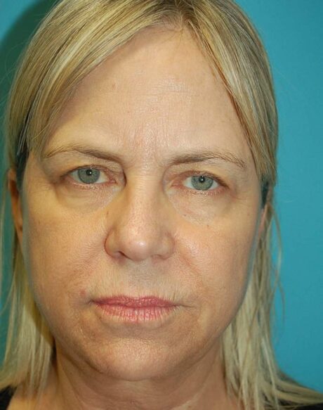 Eyelid Surgery case #3778