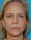 Eyelid Surgery case #3778