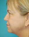 Eyelid Surgery case #3778
