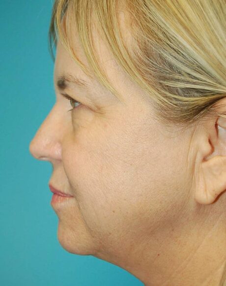 Eyelid Surgery case #3778