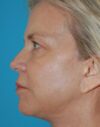 Eyelid Surgery case #3778
