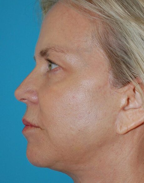 Eyelid Surgery case #3778