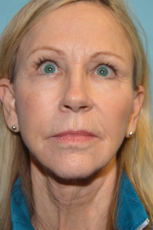 Neck Lift case #5247
