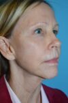 Neck Lift case #5247