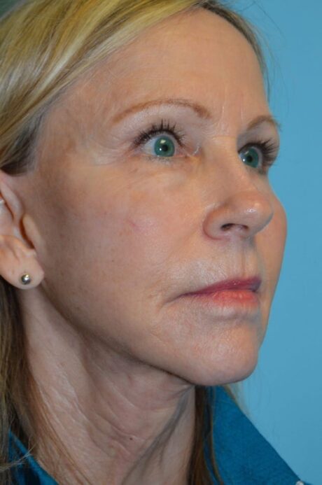Neck Lift case #5247