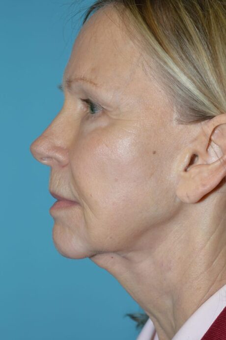 Neck Lift case #5247