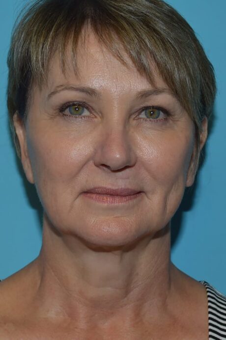 Neck Lift case #4795