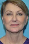 Neck Lift case #4795
