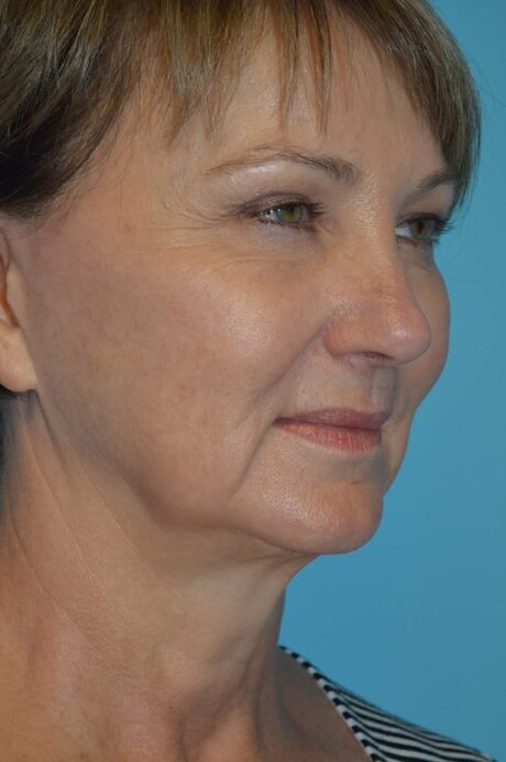 Neck Lift case #4795