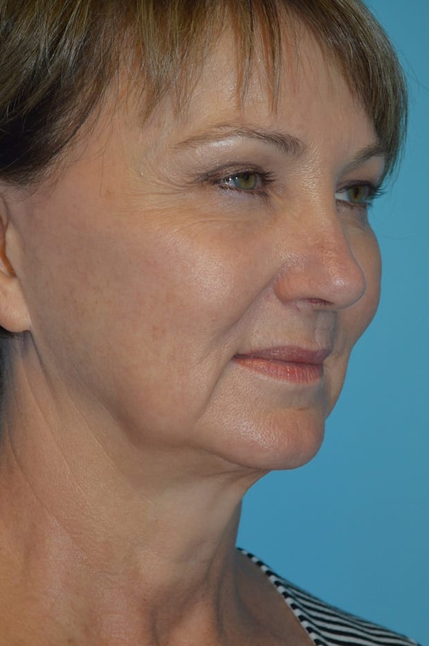 Neck Lift case #4795