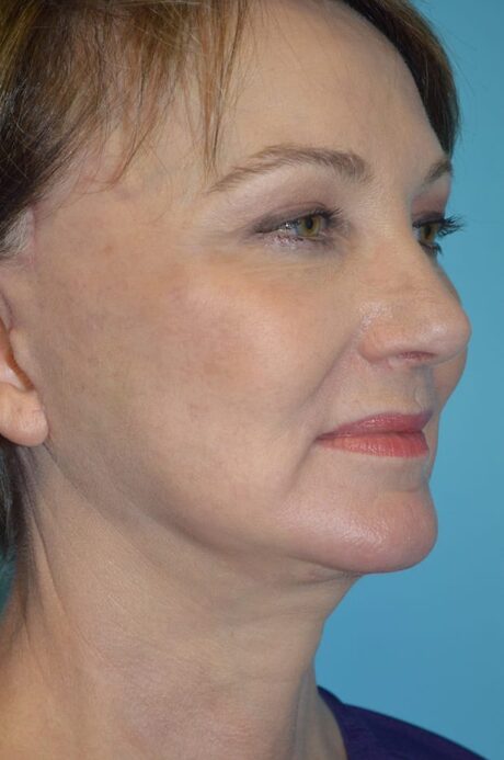 Neck Lift case #4795