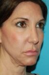 Forehead Lift case #5278