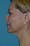 Neck Lift case #5283