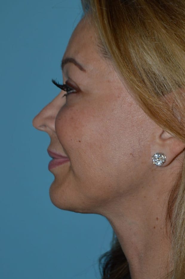 Neck Lift case #5283